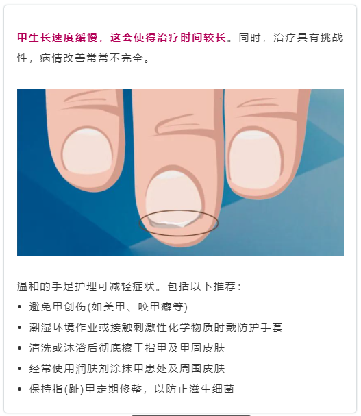 华山医院皮肤科博士来支招:指甲上的银屑病要这样治疗!