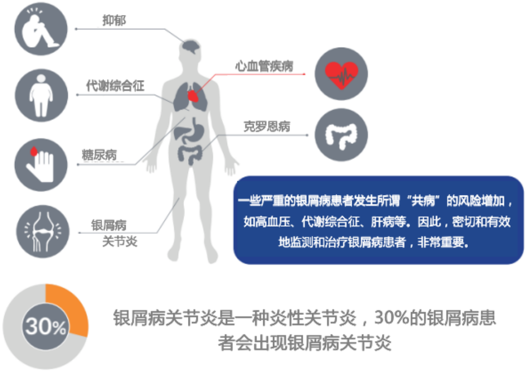 别再只把银屑病当做是皮肤病