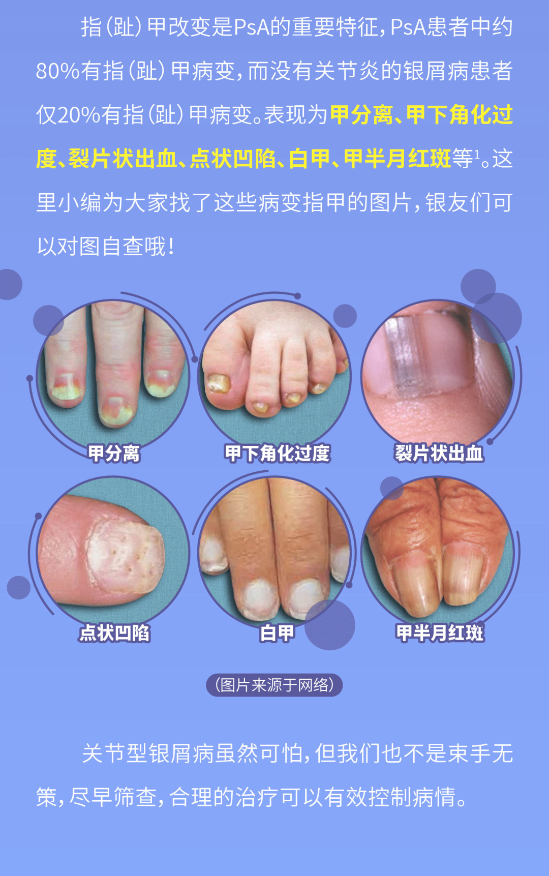 关节出现这些症状，需警惕关节型银屑病的发生