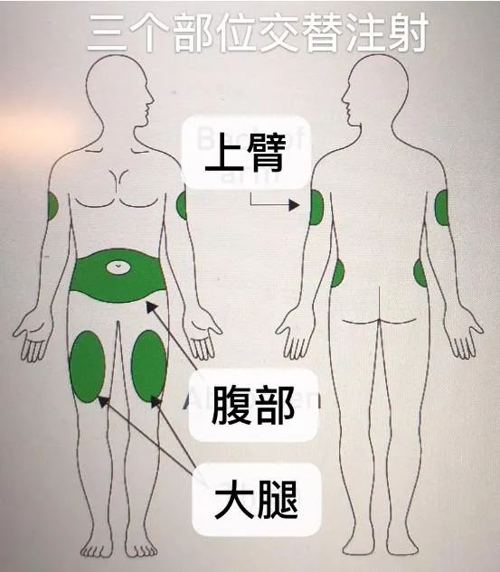 减轻注射生物制剂疼痛的8种方法
