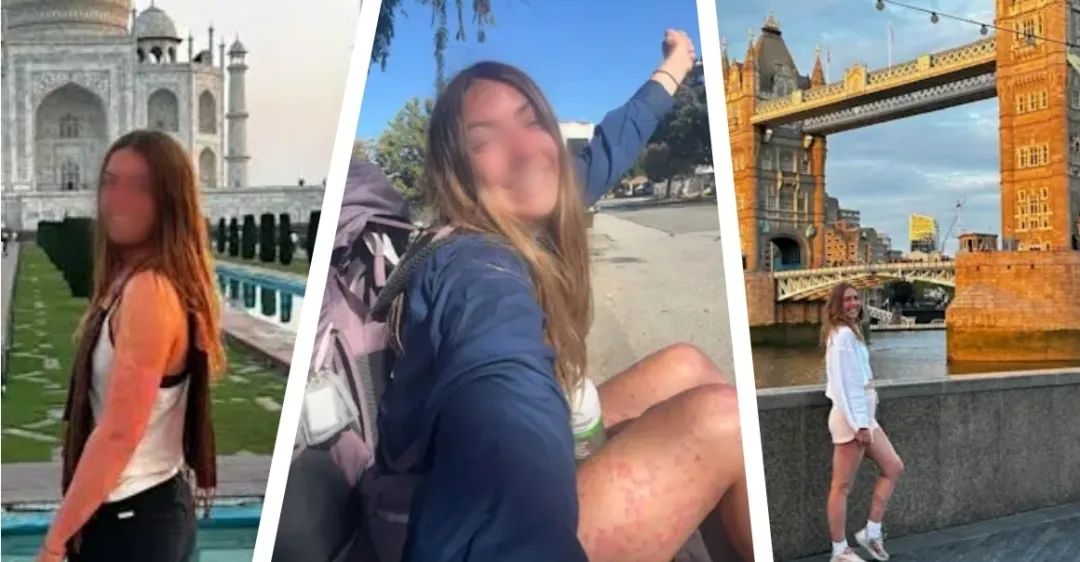 带着银屑病游世界:澳大利亚女孩与疾病的“和解”之旅