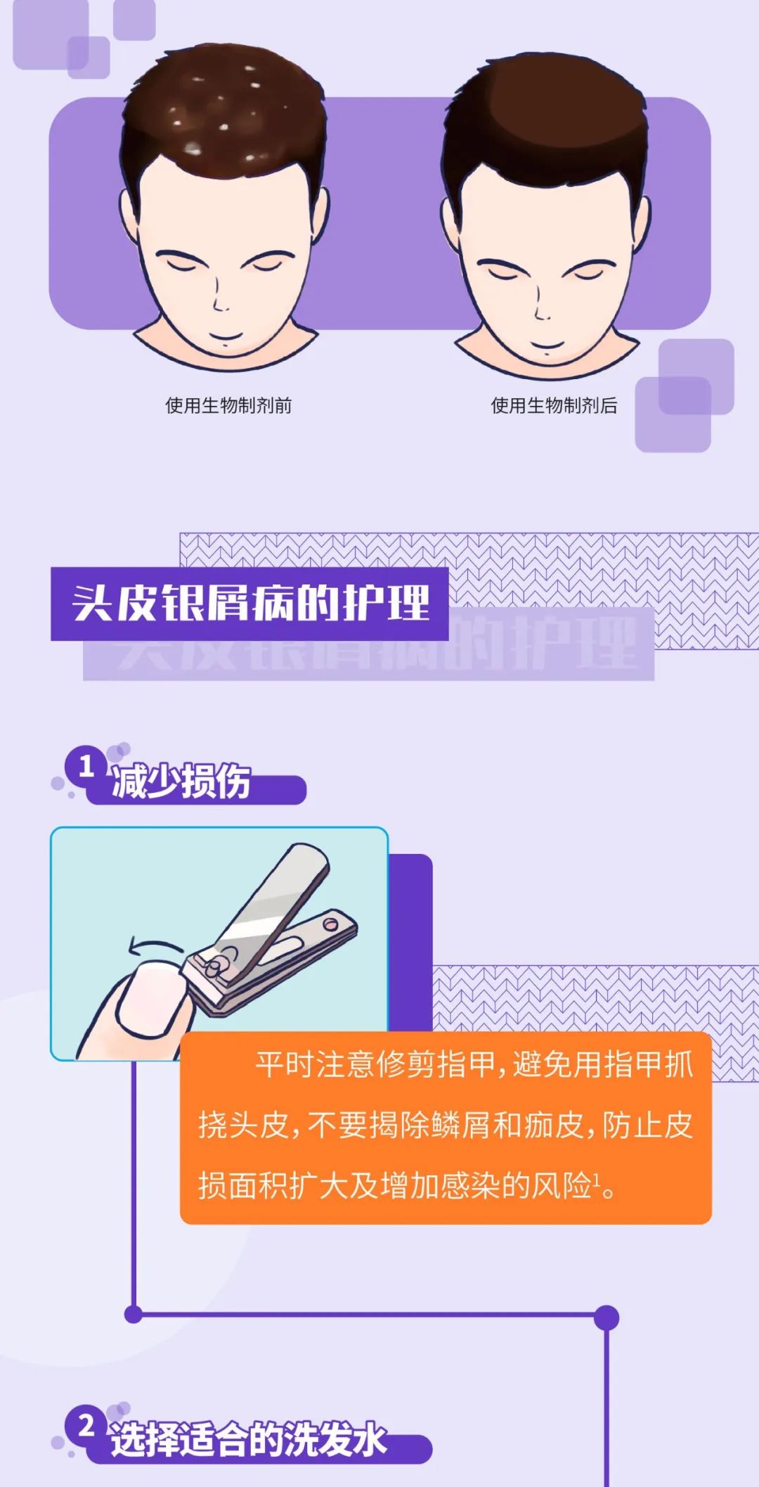 头皮银屑病的治疗与护理攻略
