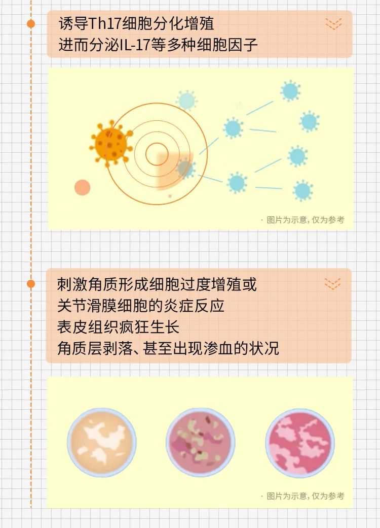 西京皮肤医院王刚院长带你走进医学，发现银屑病的起因