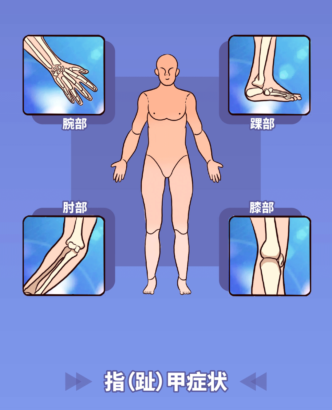 关节出现这些症状，需警惕关节型银屑病的发生