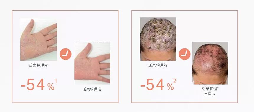 银屑病辅助治疗 之 活泉水疗