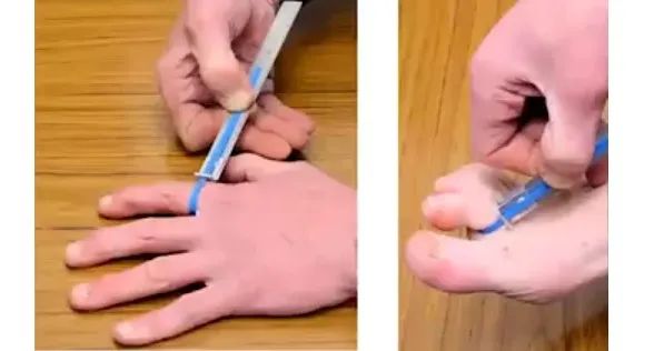 银屑病关节炎疾病活动度如何评估？还是得靠这个「法宝」！