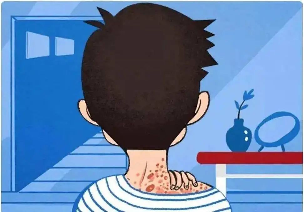 银屑病的相关知识，您真的了解吗？