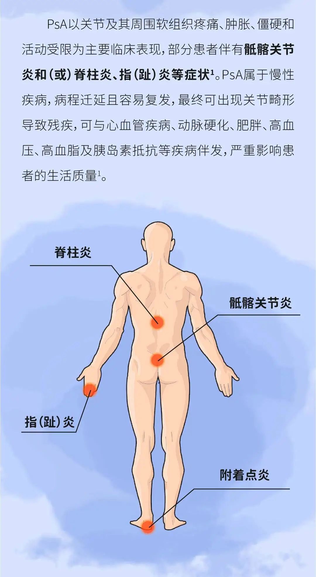 银屑病关节炎（PsA）应该控制到什么程度？