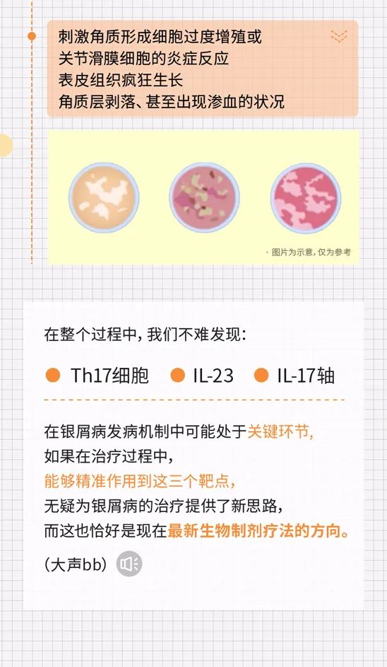 为什么是我得银屑病？