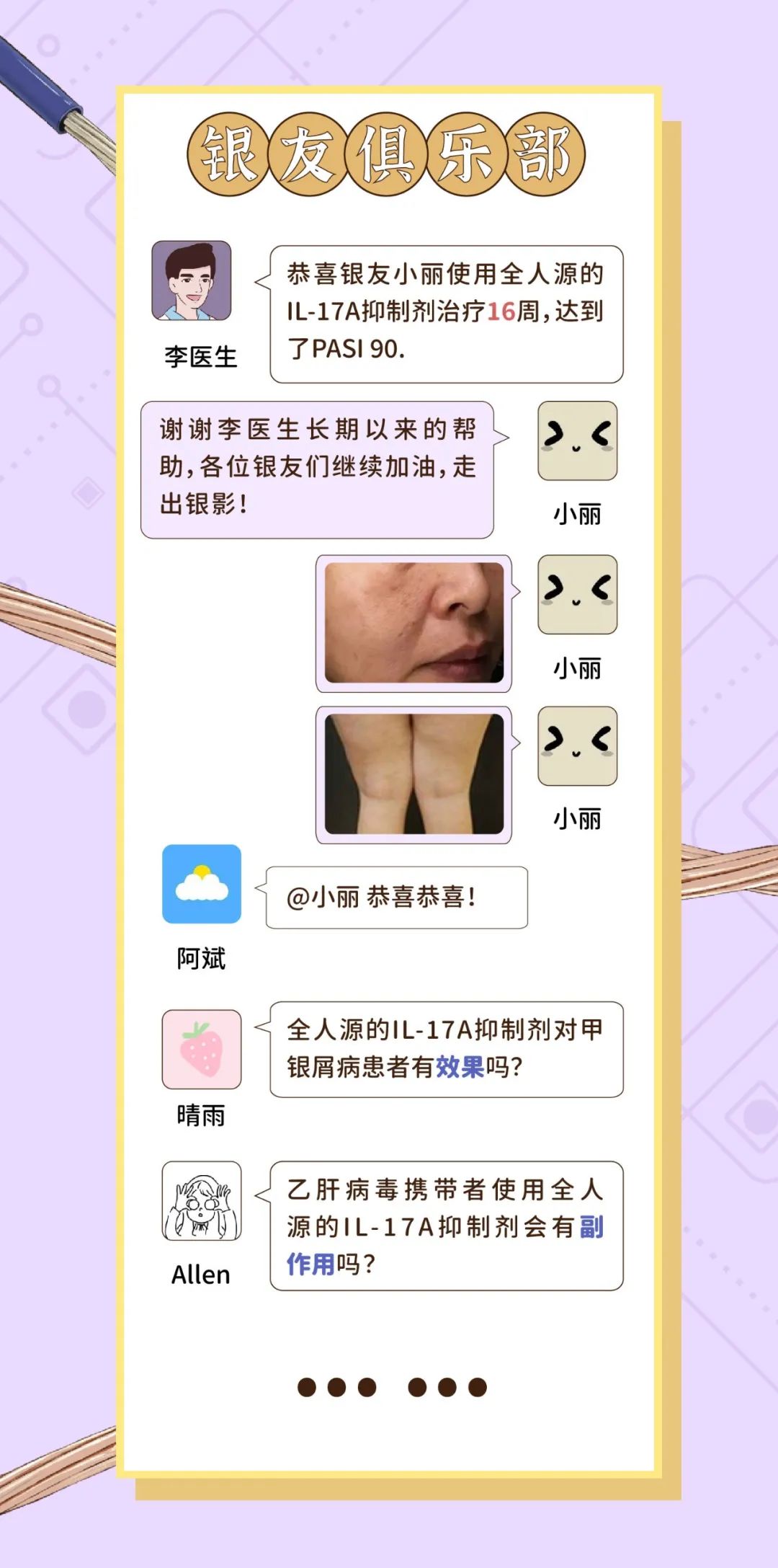 全人源的IL-17抑制剂在特殊人群中的应用