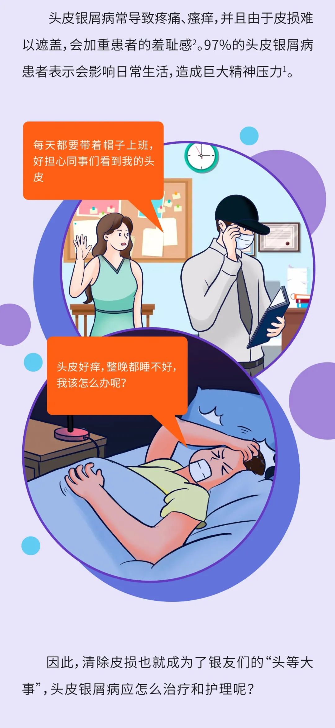 头皮银屑病的治疗与护理攻略