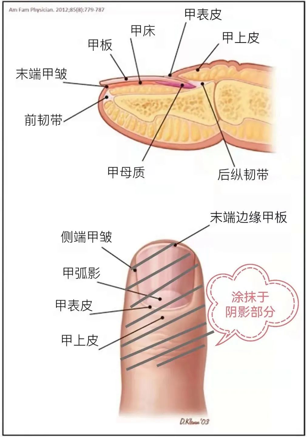 治疗甲银屑病，药膏擦在哪里最好？
