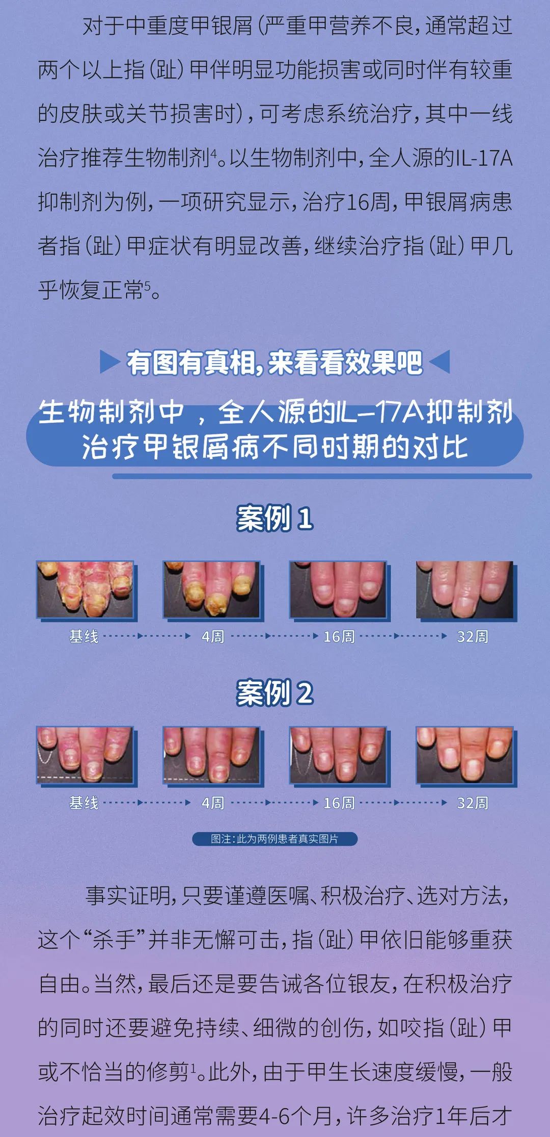 如果你的指（趾）甲出现这些情况，当心是“甲银屑病”！
