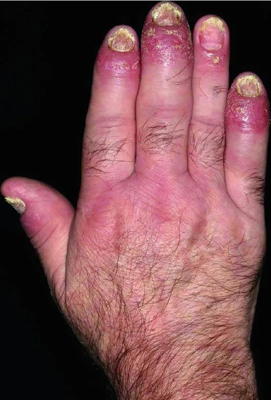 银屑病临床表现与治疗现状（一）