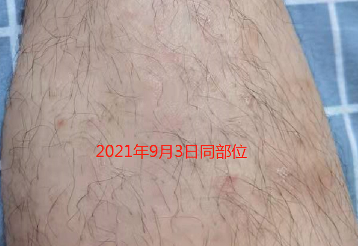 接种COVID-19疫苗，还能治好银屑病？