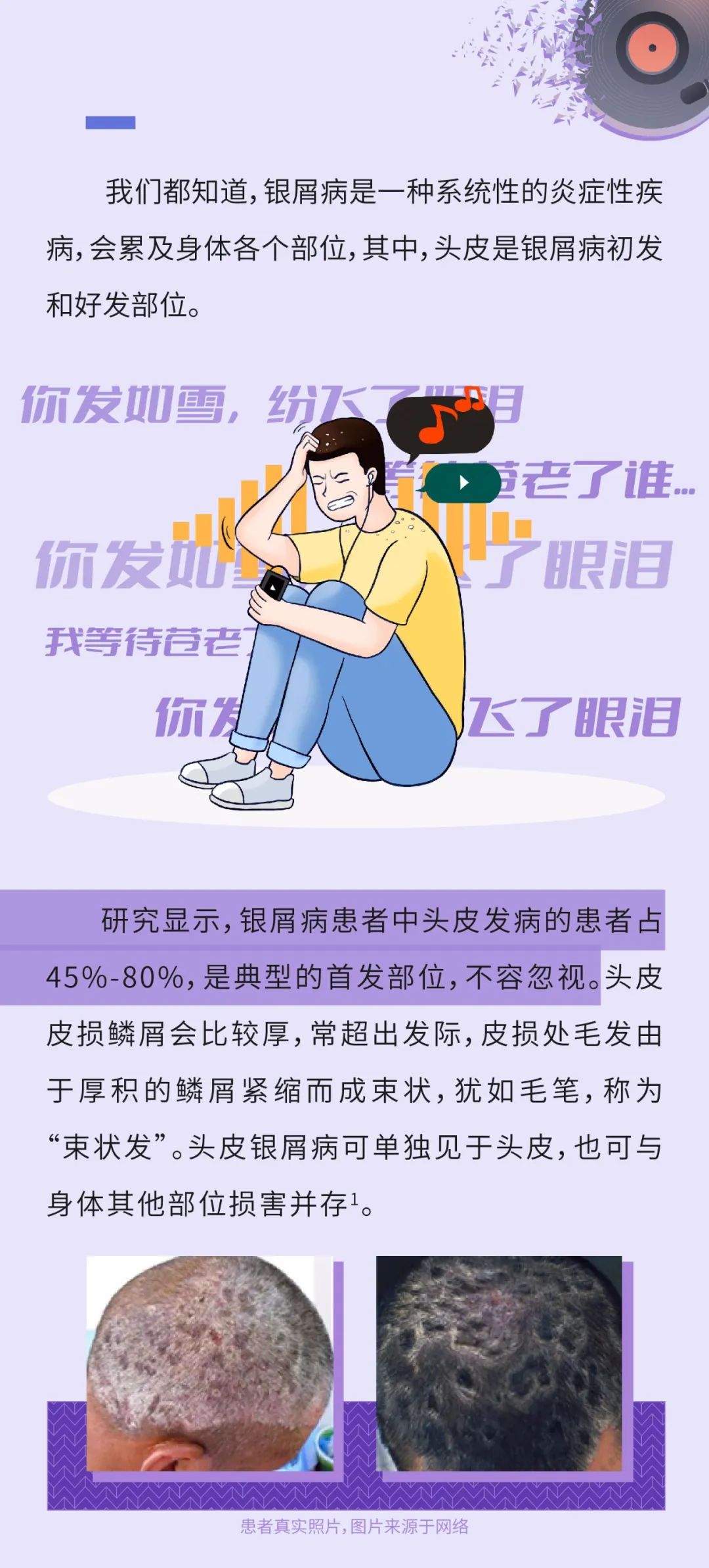 头皮银屑病的治疗与护理攻略