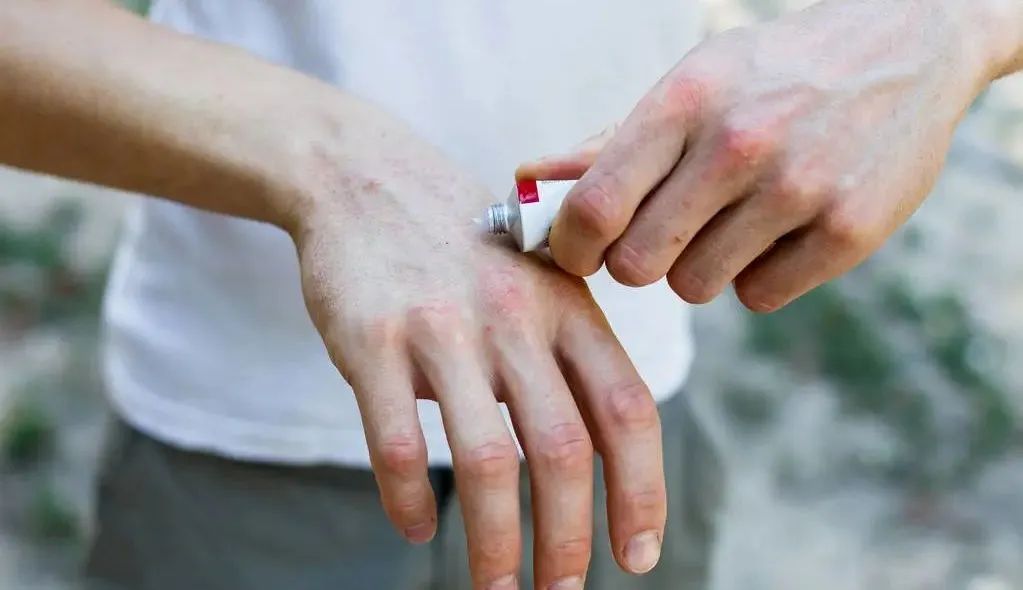 有助缓解银屑病的非处方疗法
