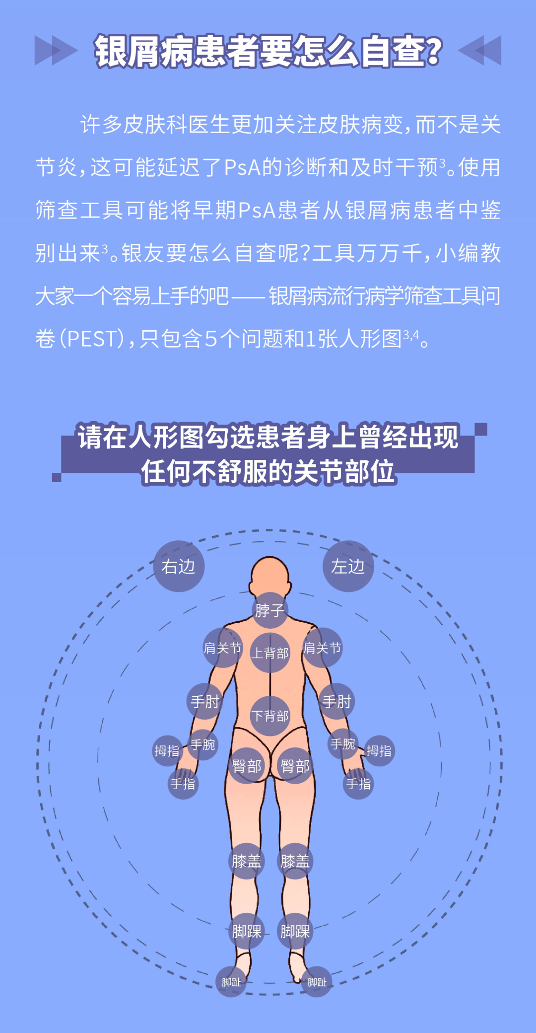 关节出现这些症状，需警惕关节型银屑病的发生