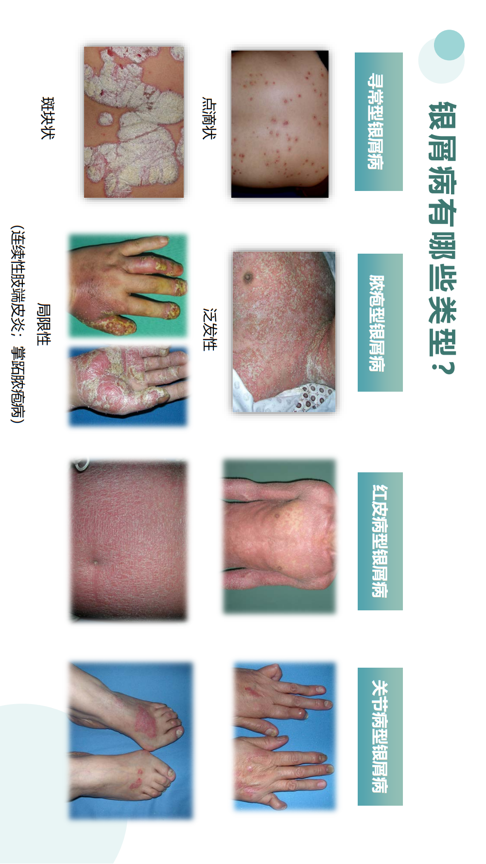 【银屑病科普手册】治疗用药、生物制剂疗法、疾病管理，患者必看