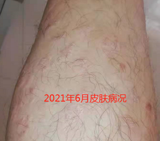接种COVID-19疫苗，还能治好银屑病？