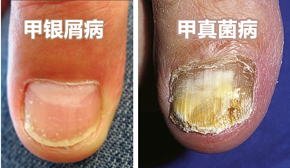 治疗甲银屑病,药膏擦在哪里最好?