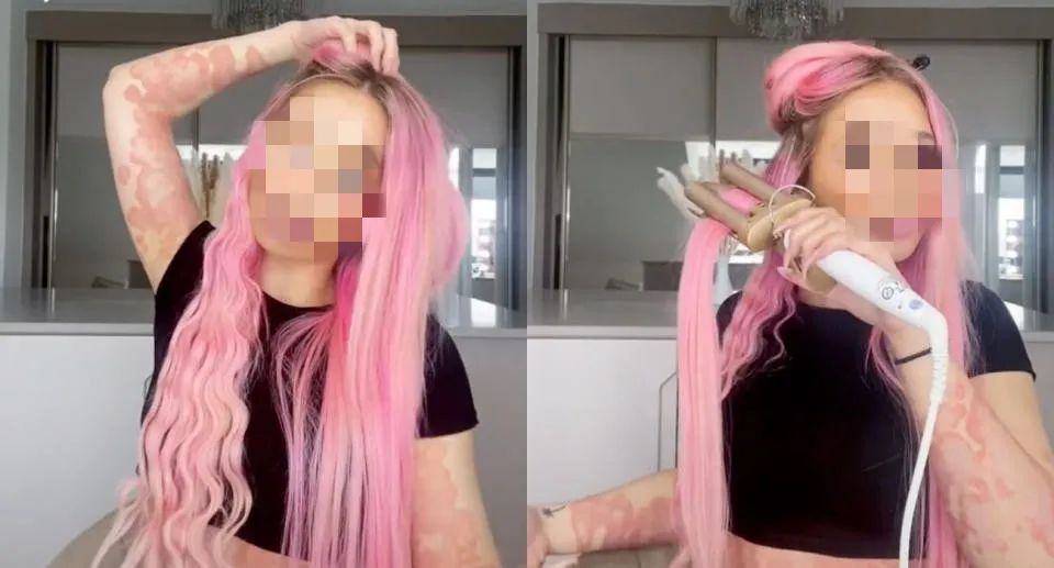 TikTok百万网红分享患银故事：它覆盖了我90%的身体！