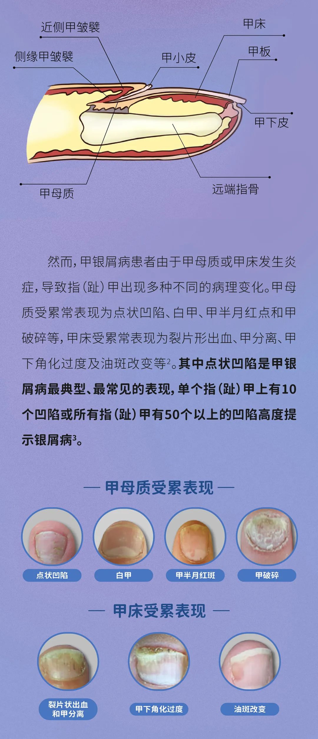如果你的指（趾）甲出现这些情况，当心是“甲银屑病”！